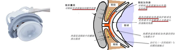 【眼健康科普课堂】干眼治疗新技术LipiFlow落户永州爱尔眼科医院(图7)